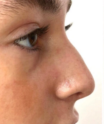 SEC 3 Liquid Rhinoplasty Before