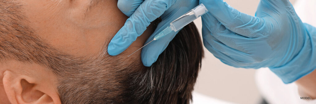 PRP Hair Treatment