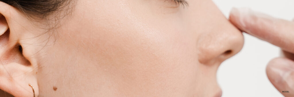 Exploring Non-Surgical Rhinoplasty