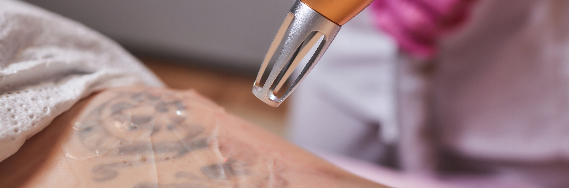 Blog 1 Laser Tattoo Removal