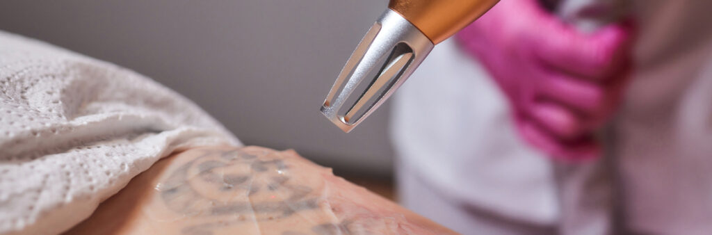 Tattoo Removal For Sensitive Skin - Bowling Green, Ohio