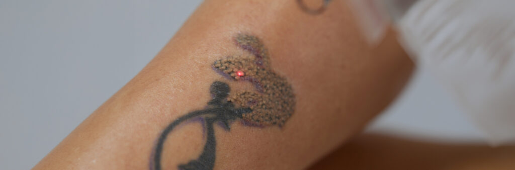 What to Expect After First Laser Tattoo Removal - Dose Aesthetics - Bowling Green, Ohio