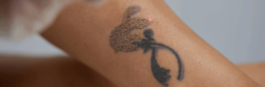 Tattoo Removal On Dark Skin - Dose Aesthetics - Bowling Green, Ohio