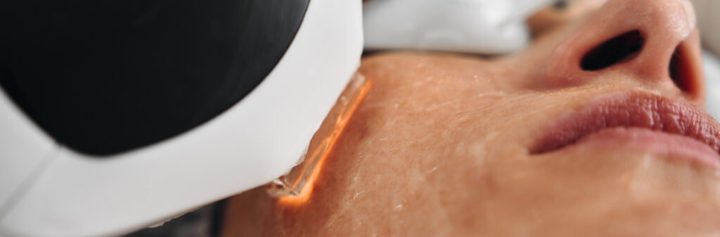 Dark Spot Laser Removal - Dose Aesthetics - Bowling Green, Ohio