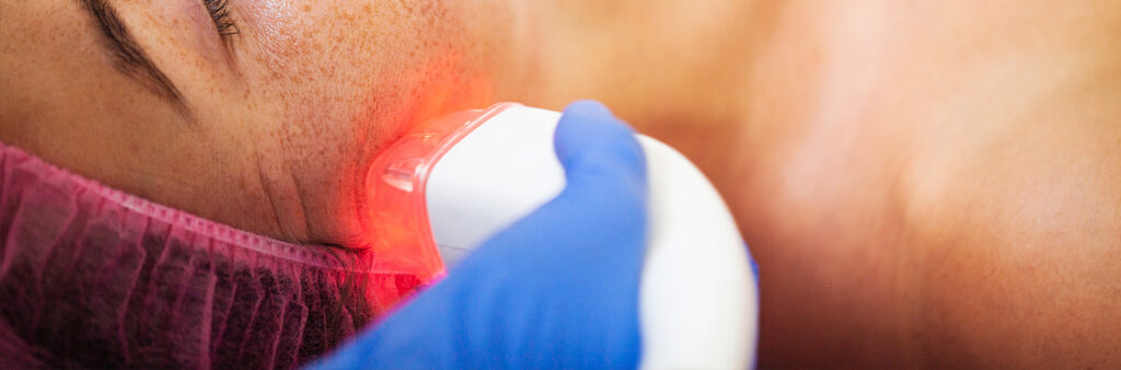 Melasma Treatment for Sensitive Skin - Dose Aesthetics