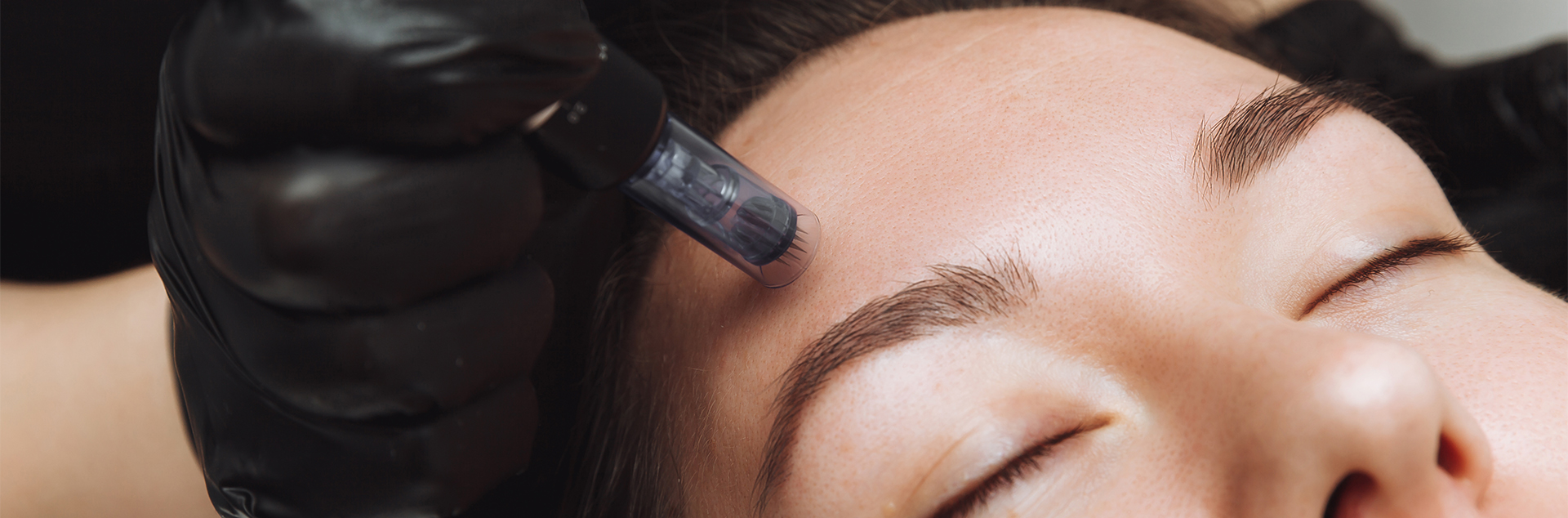 Microneedling Candidate - Dose Aesthetics - Bowling Green & Maumee, Ohio