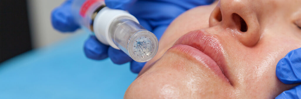 Microneedling For Stretch Marks - Dose Aesthetics - Bowling Green, Ohio