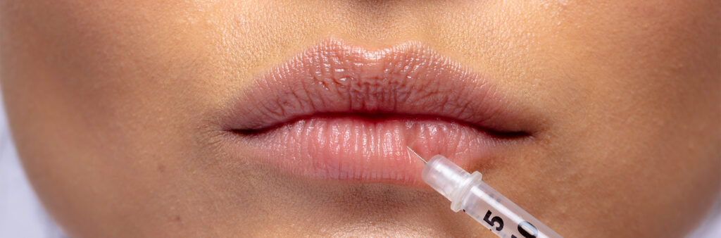 Lip Filler Swelling Stages - Dose Aesthetics -Bowling Green, Maumee and Toledo, Ohio