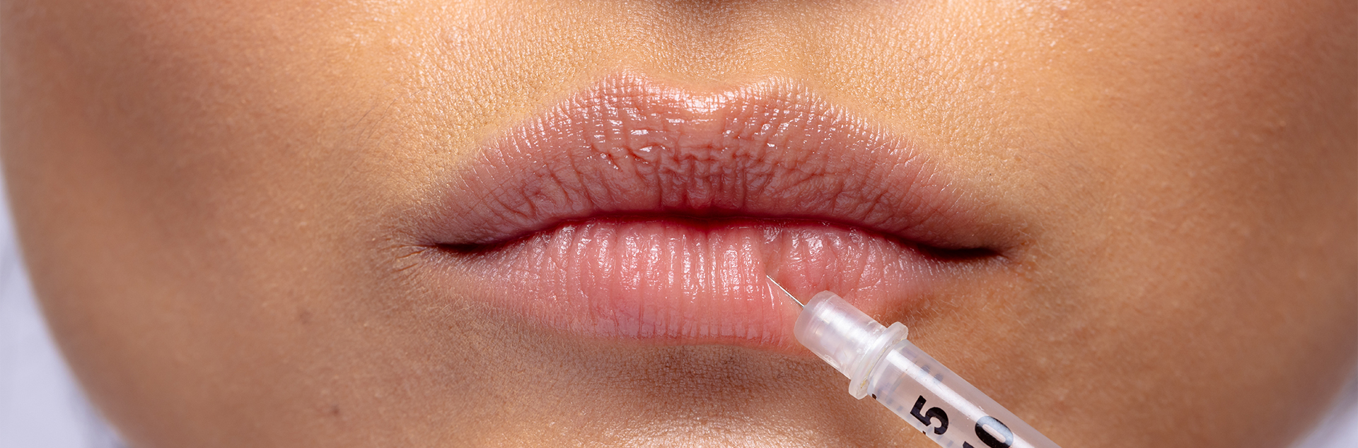 Lip Filler Swelling Stages - Dose Aesthetics -Bowling Green, Maumee and Toledo, Ohio