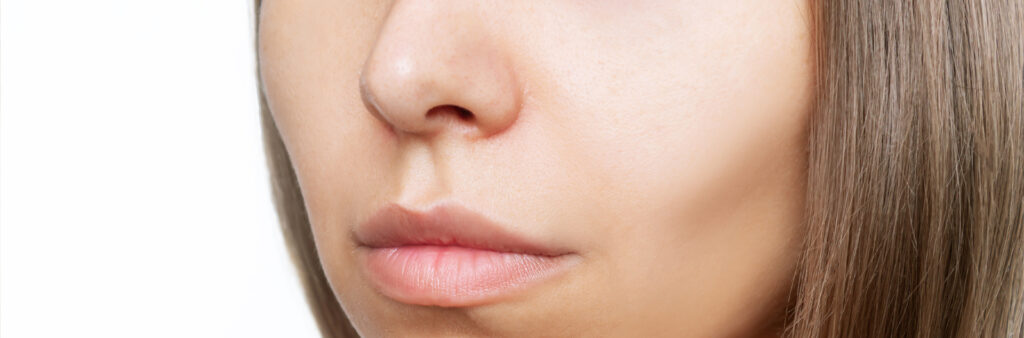 Cheek Fillers: Instantly Lift & Sculpt 3 Cheek Fillers - Dose Aesthetics - Bowling Green, Toledo, Maumee, Ohio