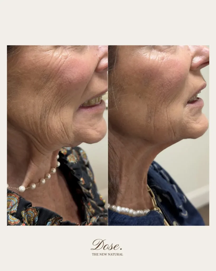 A subtle lift. A smoother profile. A more defined jawline. ✨Our Nefertiti Neck Lift uses strateg 819x1024 1