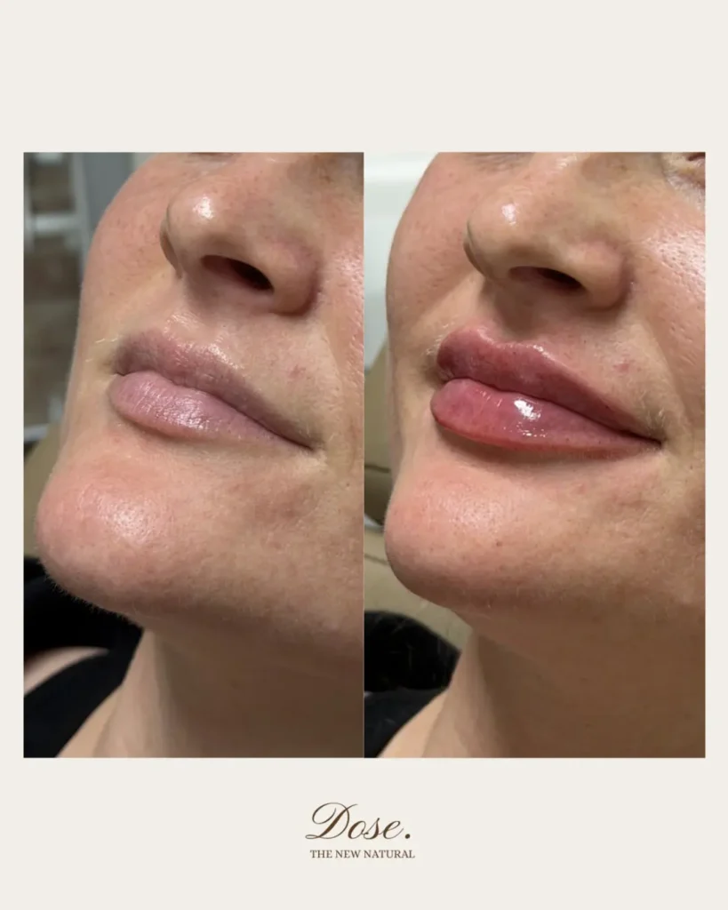 A summertime favorite hydrated healthy lips. ☀️Sun pool days and long weekends can leave lip 819x1024 1