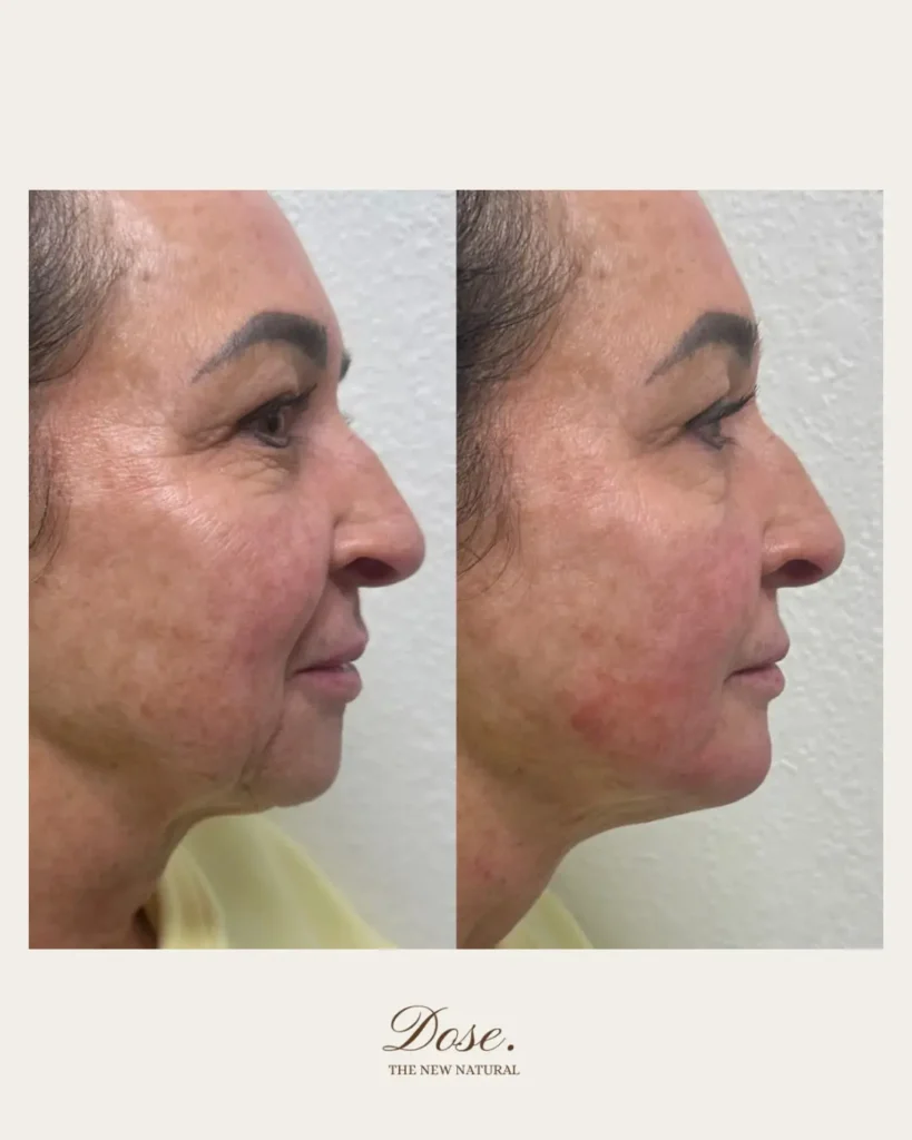 Sculpted defined effortlessly youSubtle filler can sculpt define and elevate your profile — 819x1024 1