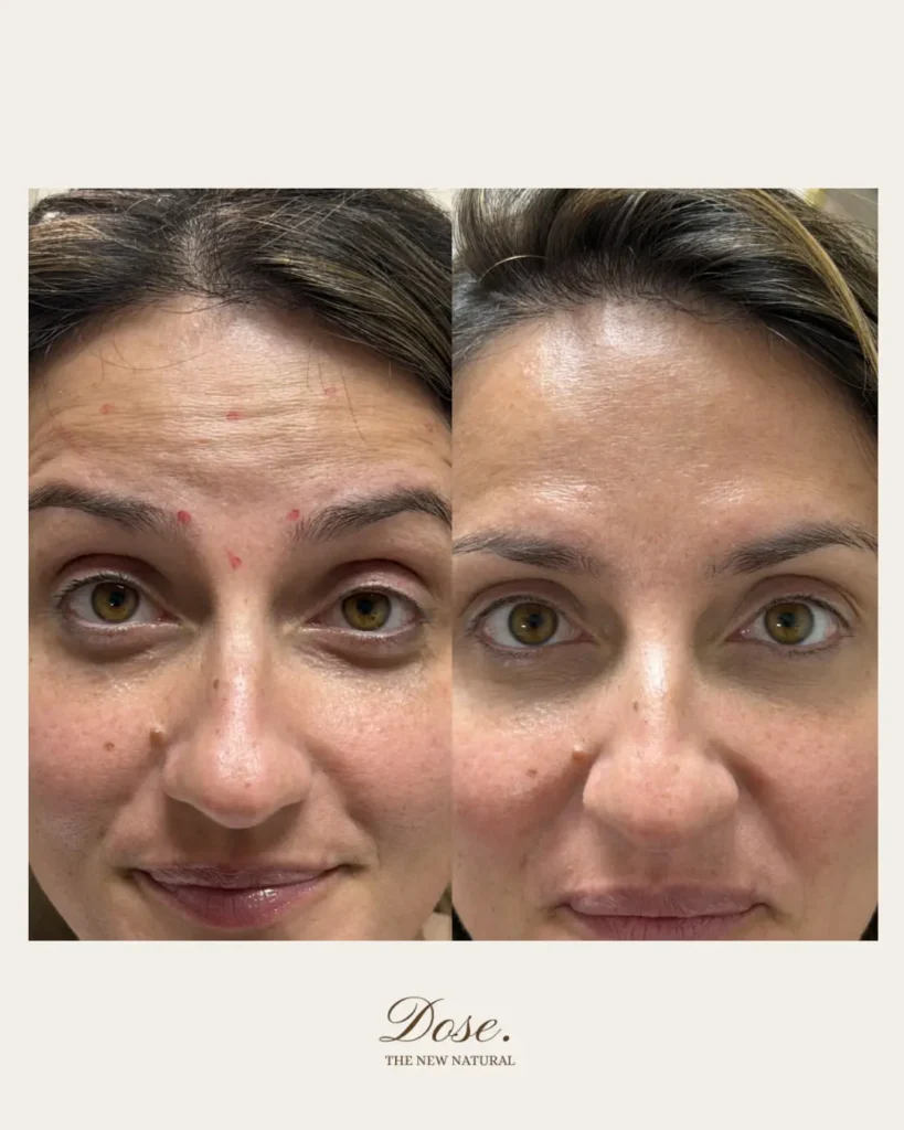 Soft smooth and still you—just refreshed 💉🤍 819x1024 1